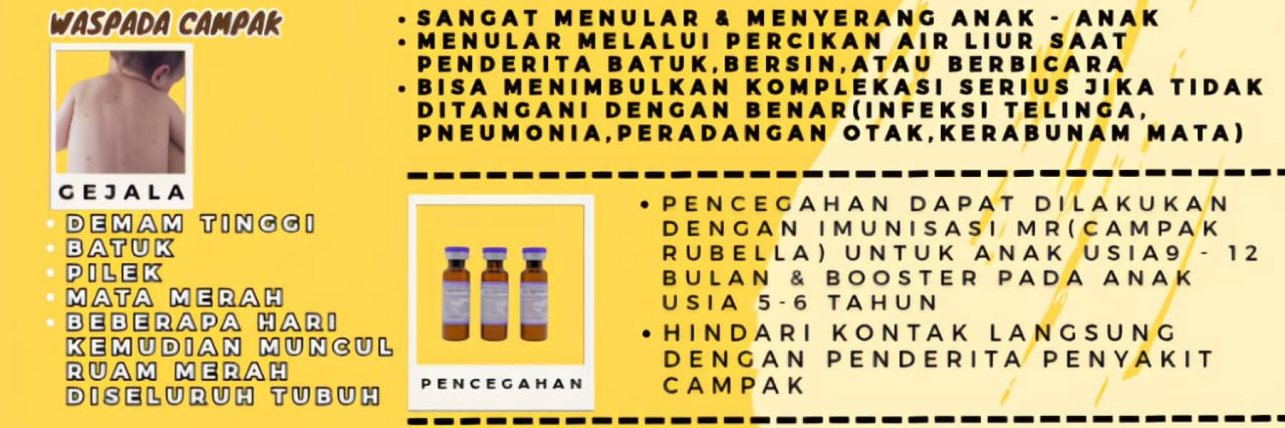 campak